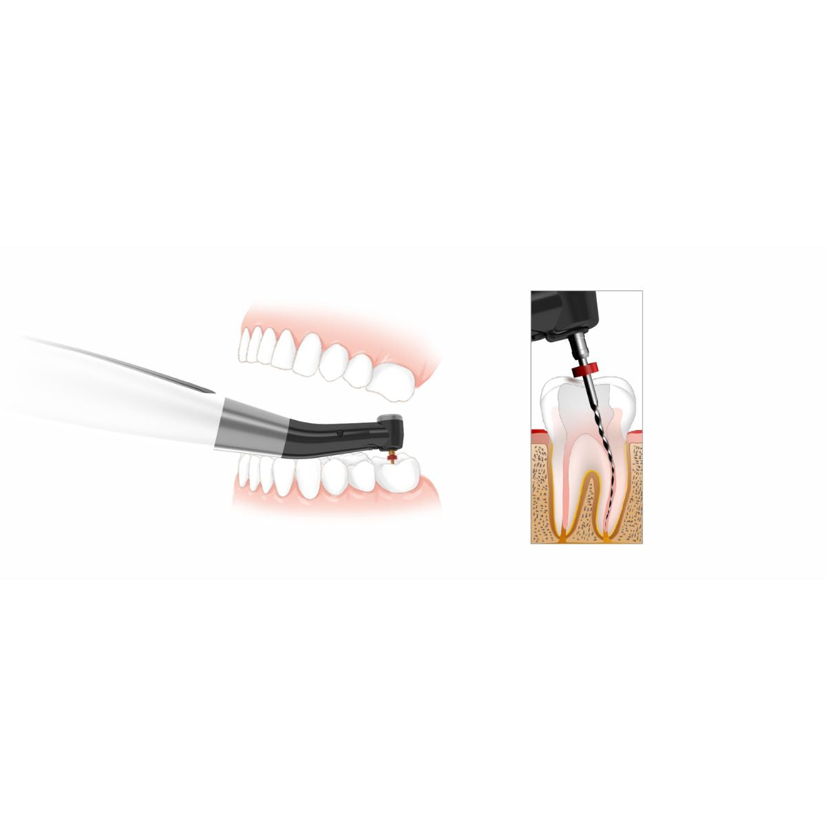 Woodpecker 1.8:1 Dental Reciprocating Contra Angle Handpiece CA 221